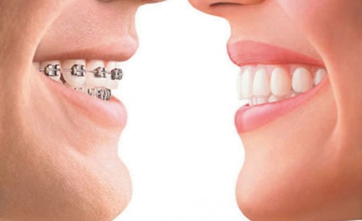 Σιδεράκια και στραβά δόντια. Τι προσφέρει η ορθοδοντική θεραπεία;