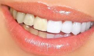 Κίτρινα δόντια - Πώς να απαλλαγείτε!